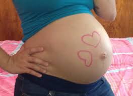 Hernia umbilical en embarazo